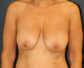 Feel Beautiful - Breast Lift with Implants 70 - Before Photo